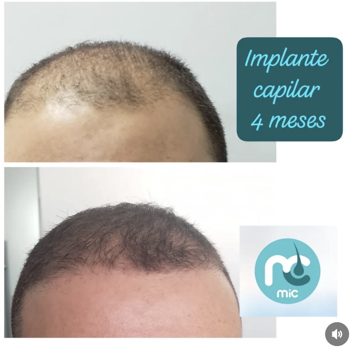 hair growth