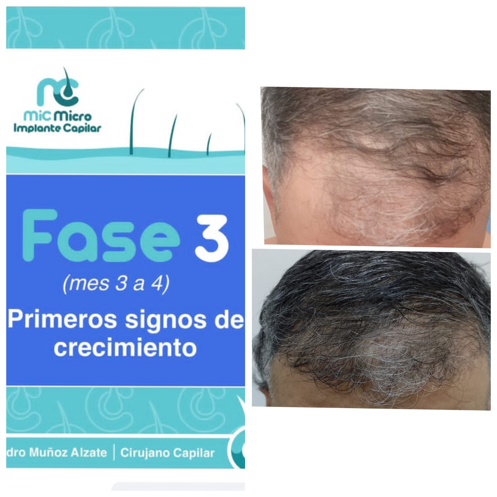 FUE Hair Transplant